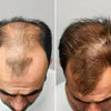 Proskire Hair Growth Serum – Reduces Hair Fall, Boosts Hair Density, Activates Follicles – For Bald Patches, Receding Hairline & Thinning Hair MISO DEALS
