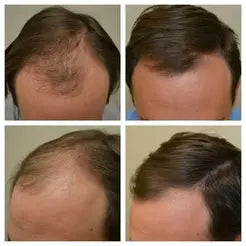 Proskire Hair Growth Serum – Reduces Hair Fall, Boosts Hair Density, Activates Follicles – For Bald Patches, Receding Hairline & Thinning Hair MISO DEALS