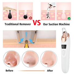 Digital Blackhead Remover Vacuum – Electric Pore Cleaner & Acne Facial Tool