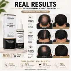 Proskire Hair Growth Serum – Reduces Hair Fall, Boosts Hair Density, Activates Follicles – For Bald Patches, Receding Hairline & Thinning Hair MISO DEALS